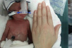 北京：国内胎龄最小“巴掌婴儿”出院 24周出生